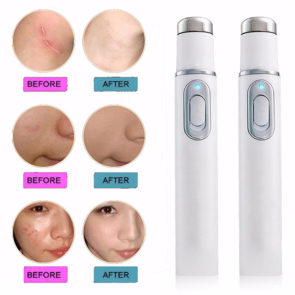 Blauwlichttherapie Acne Pen Ve - Acne Light Therapy Pen recensie en prijs